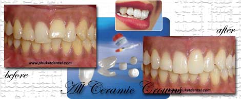 All ceramic crowns&bridges:Phuket Dentist,Thailand